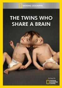 The Twins Who Share A Brain