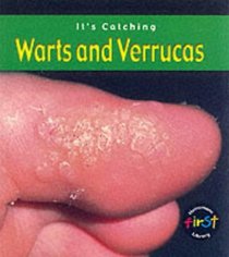 Warts and Verrucas (Its Catching)