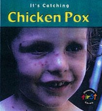 Chickenpox (Its Catching)