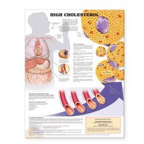 High Cholesterol Anatomical Chart