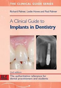A Clinical Guide to Implants in Dentistry