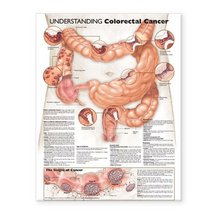 Understanding Colorectal Cancer Anatomical Chart