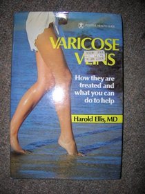 Varicose veins: How they are treated and what you can do to help (Positive health guide)