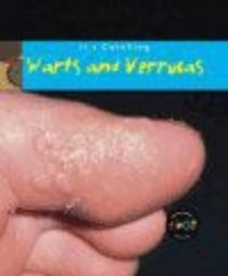 Warts and Verrucas (Its Catching)
