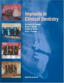 Implants in Clinical Dentistry