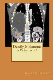 Deadly Melanoma - What is it?