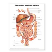 Diseases of the Digestive System Anatomical Chart in Spanish (Enfermedades del Sistema Digestivo)