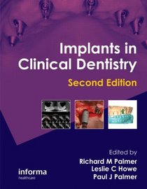 Implants in Clinical Dentistry, Second Edition