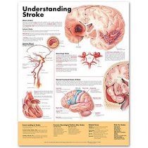 Understanding Stroke Anatomical Chart