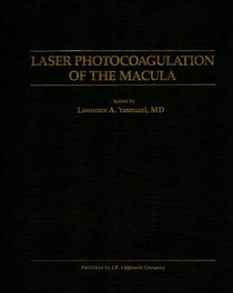 Laser Photocoagulation of the Macula
