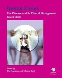 Dental Caries: The Disease and Its Clinical Management