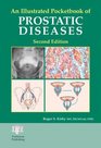 An Illustrated Pocketbook of Prostatic Disease Second Edition