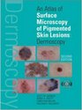 An Atlas of Surface Microscopy of Pigmented Skin Lesions : Dermoscopy,  Second Edition