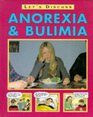 Anorexia Bulimia and Other Eating Disorders
