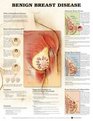 Benign Breast Disease Anatomical Chart