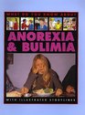 Anorexia And Bulimia