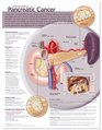 Understanding Pancreatic Cancer Anatomical Chart