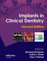 Implants in Clinical Dentistry Second Edition