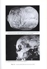 Palaeopathological and PalaeoepiDemiological Study of Osseous Syphilis in Skulls of the Edo Period
